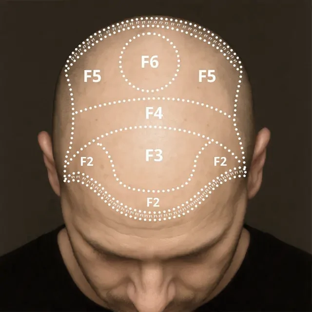 Before Hair Transplantation