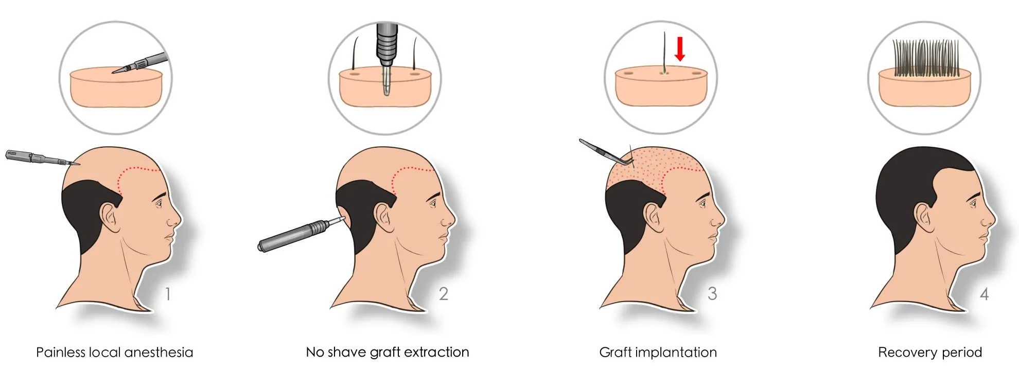 hair transplant 5000greft